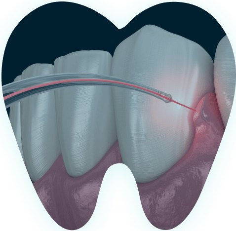 Лазер в стоматологии