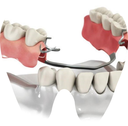Бюгельное протезирование в Днепре